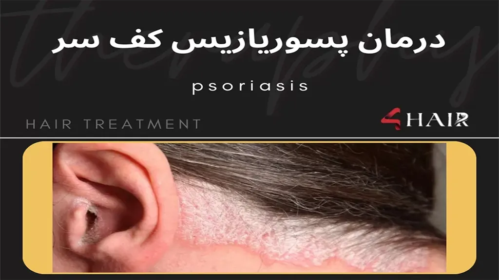 پسوریازیس چیست و روش درمان آن darmanP